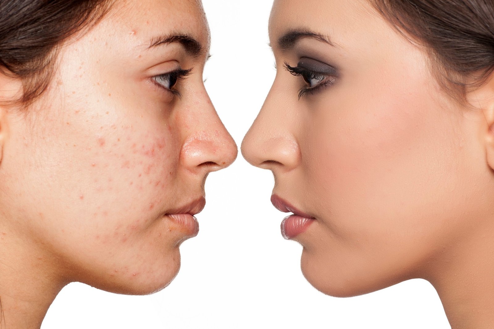 Acne Treatment in Ahmedabad