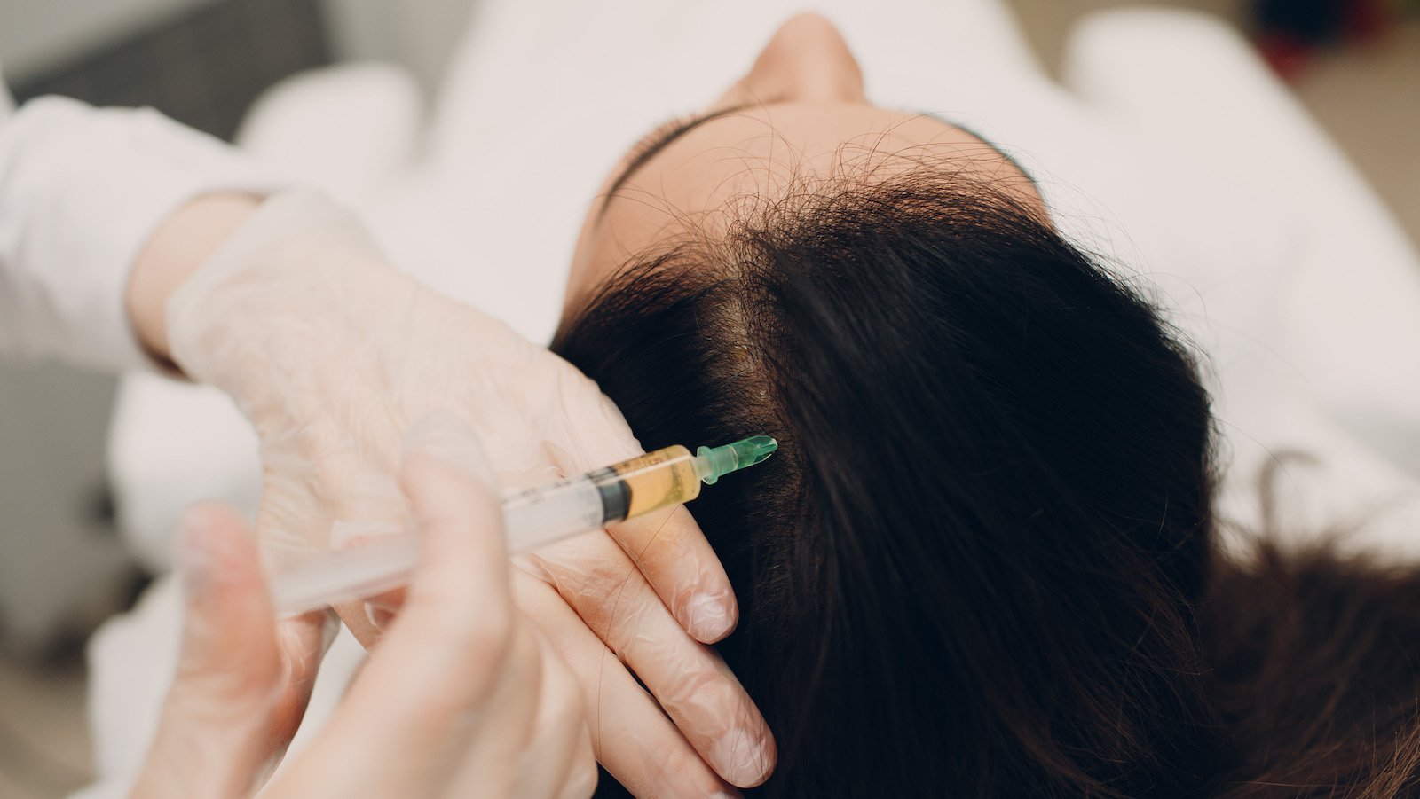 PRP Hair Restoration in Ahmedabad